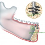 Implante Basal Roott