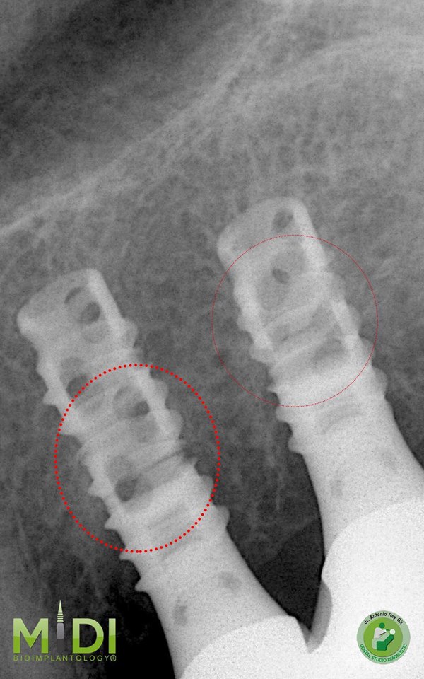 implantes sustituirlos