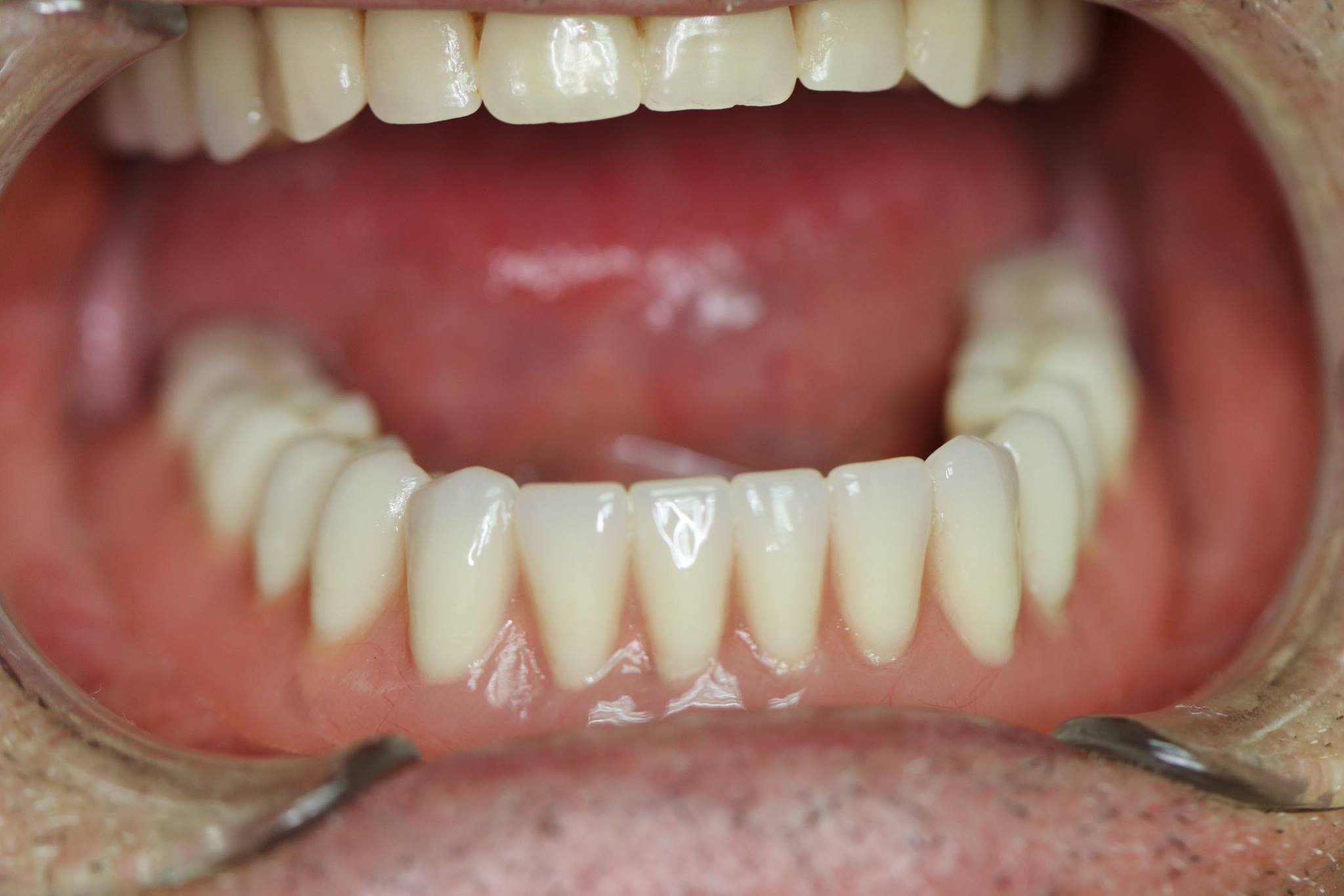implantes dentales Valladolid Dr.Rey Gil
