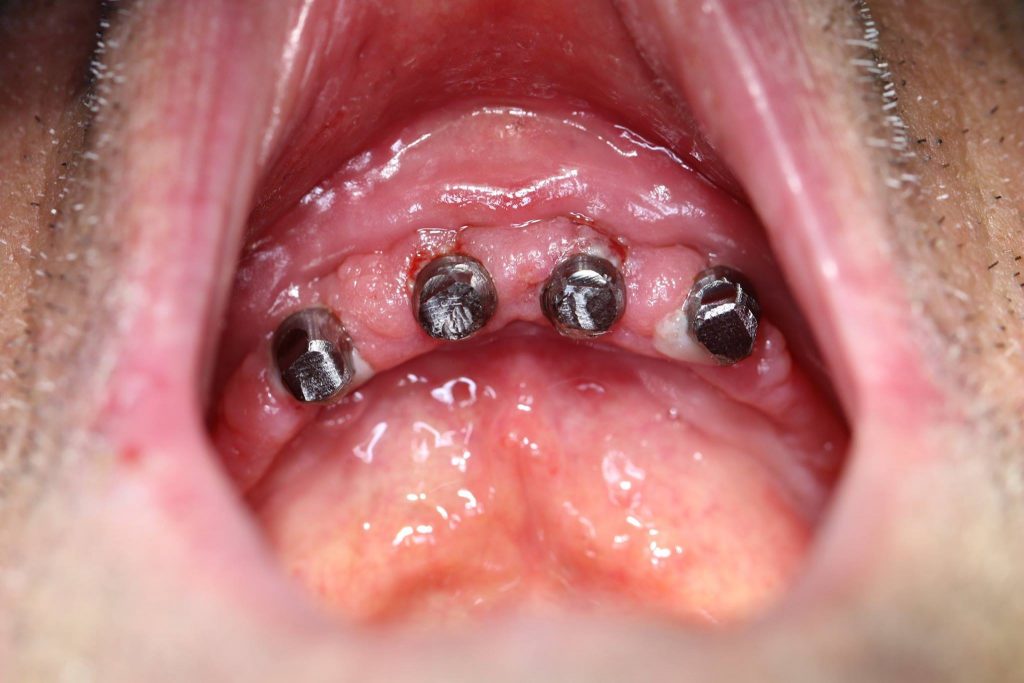 implantes dentales Valladolid Dr.Rey Gil