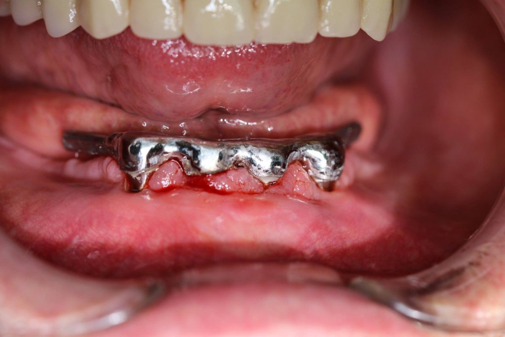 implantes dentales Valladolid Dr.Rey Gil