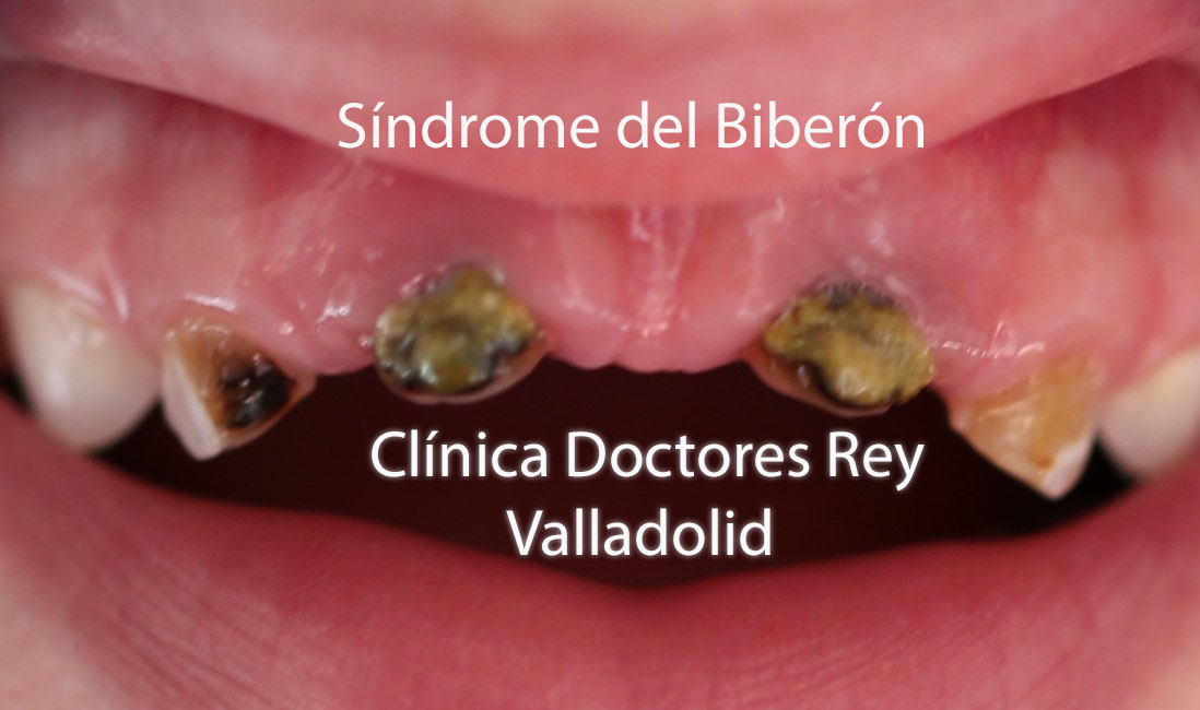 Síndrome del Biberon