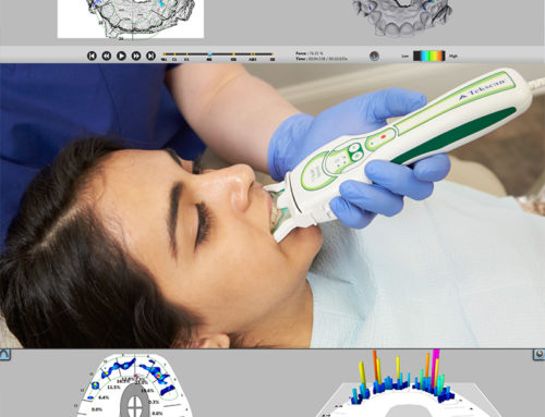 Implantes Oclusión Clinica Dental. T-Scan